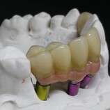 Zirconia cement retained bridge