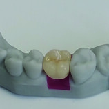 Cement retained zirconia crown on printed atlantis digital model
